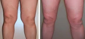 Inner knees